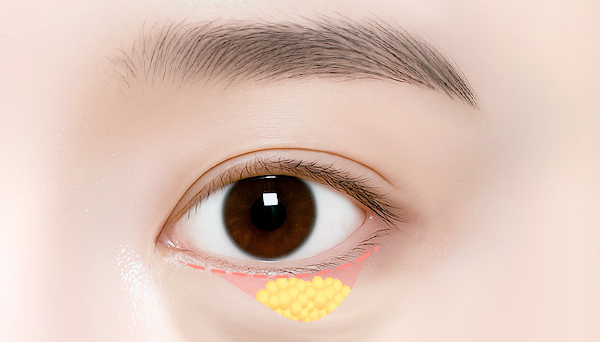 바이브성형외과 수술 일러스트